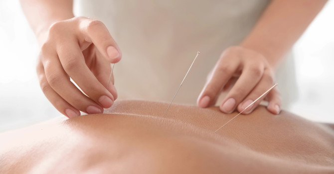 Trigger Point Dry Needling